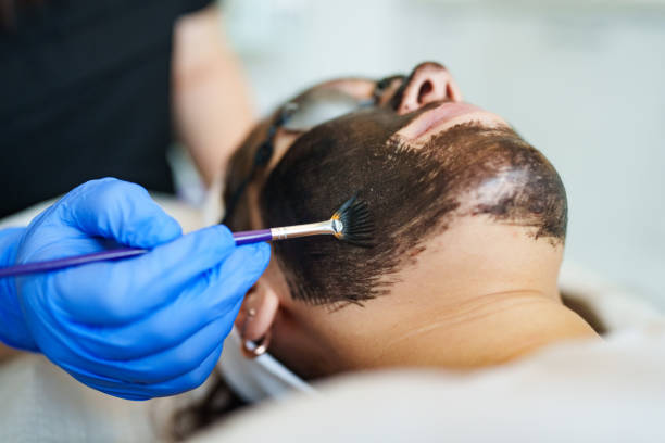 Say Goodbye to Dull Skin: Try Chemical Peel Treatments near Frisco