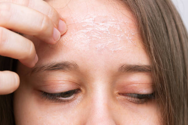 What should you expect during a chemical peel appointment in Frisco?